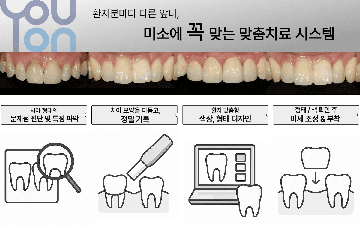 Crown Treatment