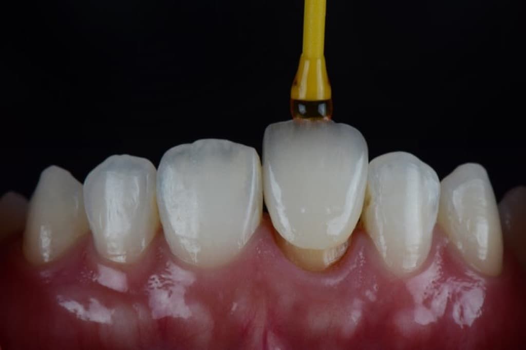 Incisor Diagnosis