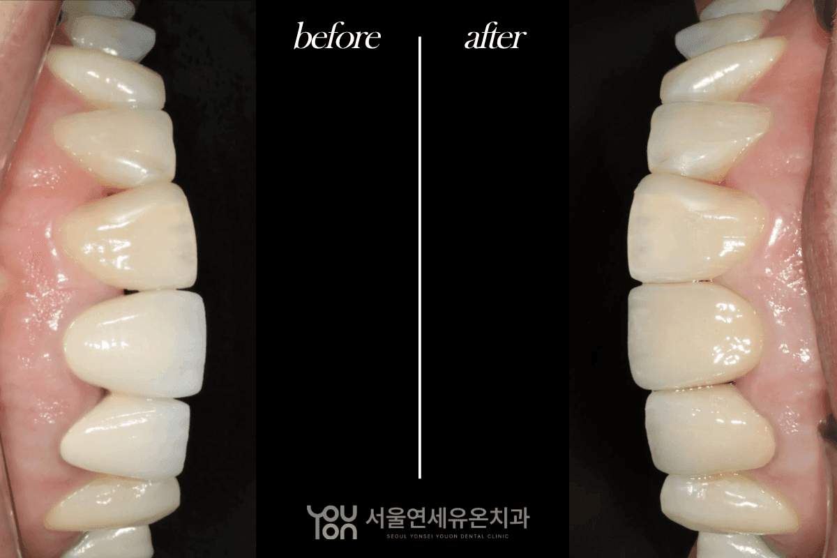 Reprosthetics Treatment