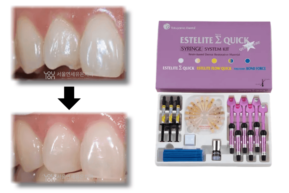 Resin Fracture Treatment