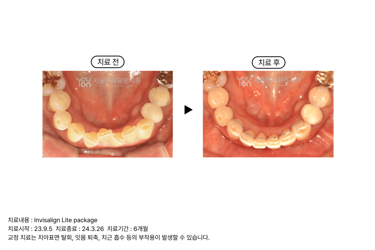 Adult Orthodontics Case