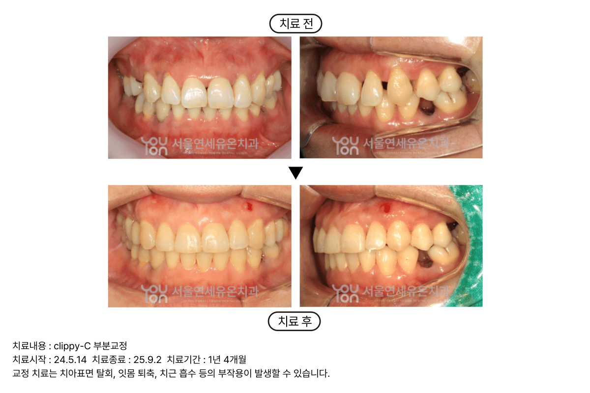Adult Orthodontics Case2