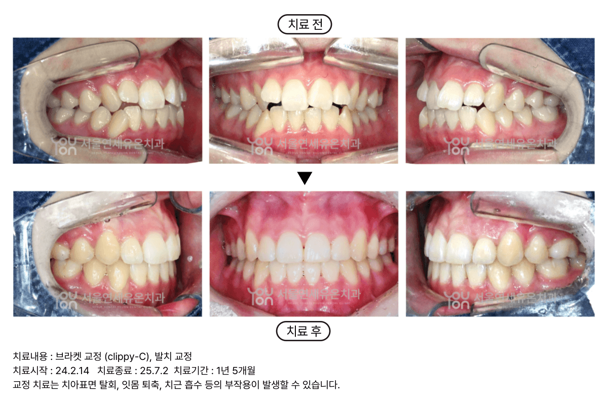 Bracket Case 1