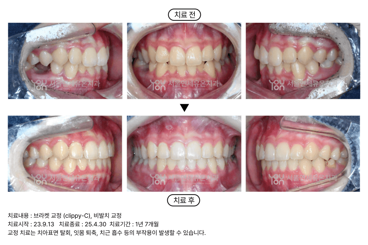 Bracket Case 2