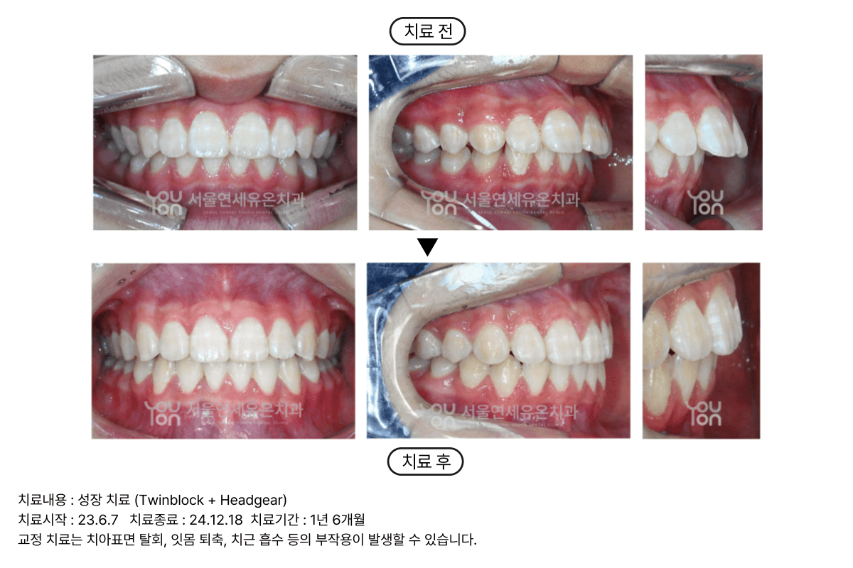 Children Orthodontics Case 1
