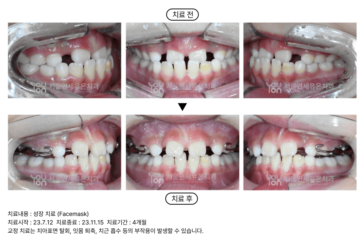 Children Orthodontics Case 2