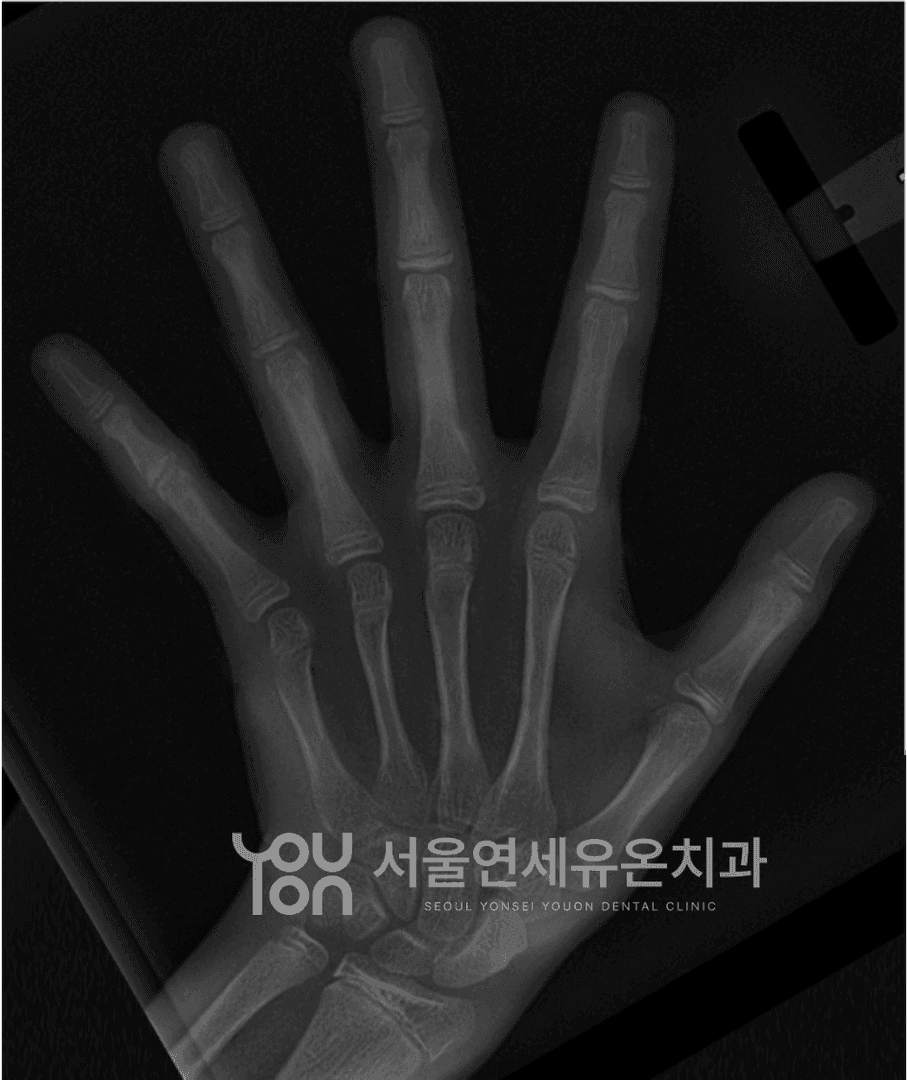 Hand Wrist X-ray Analysis