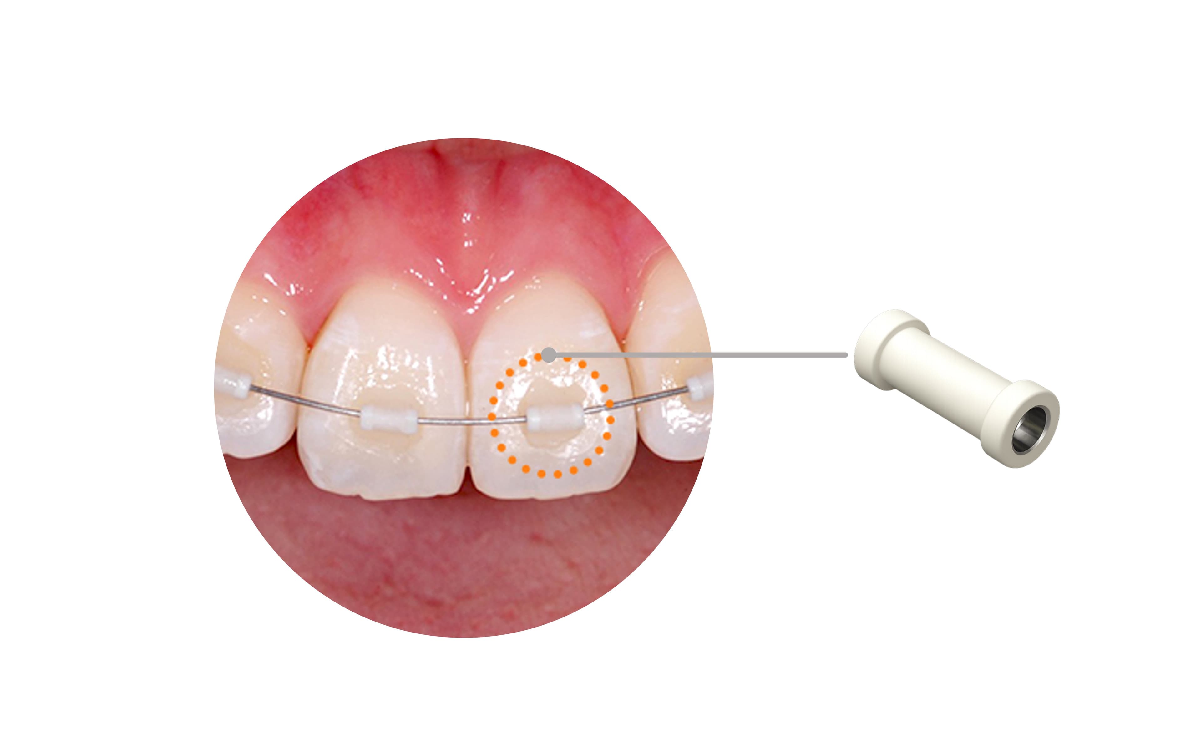 Incisor Orthodontics
