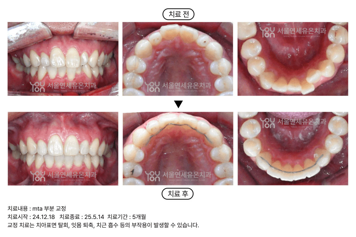 Incisor Orthodontics Case