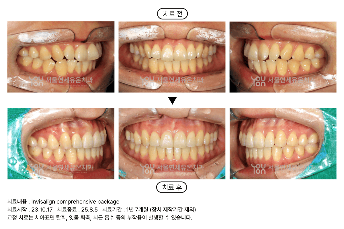 Invisalign Case