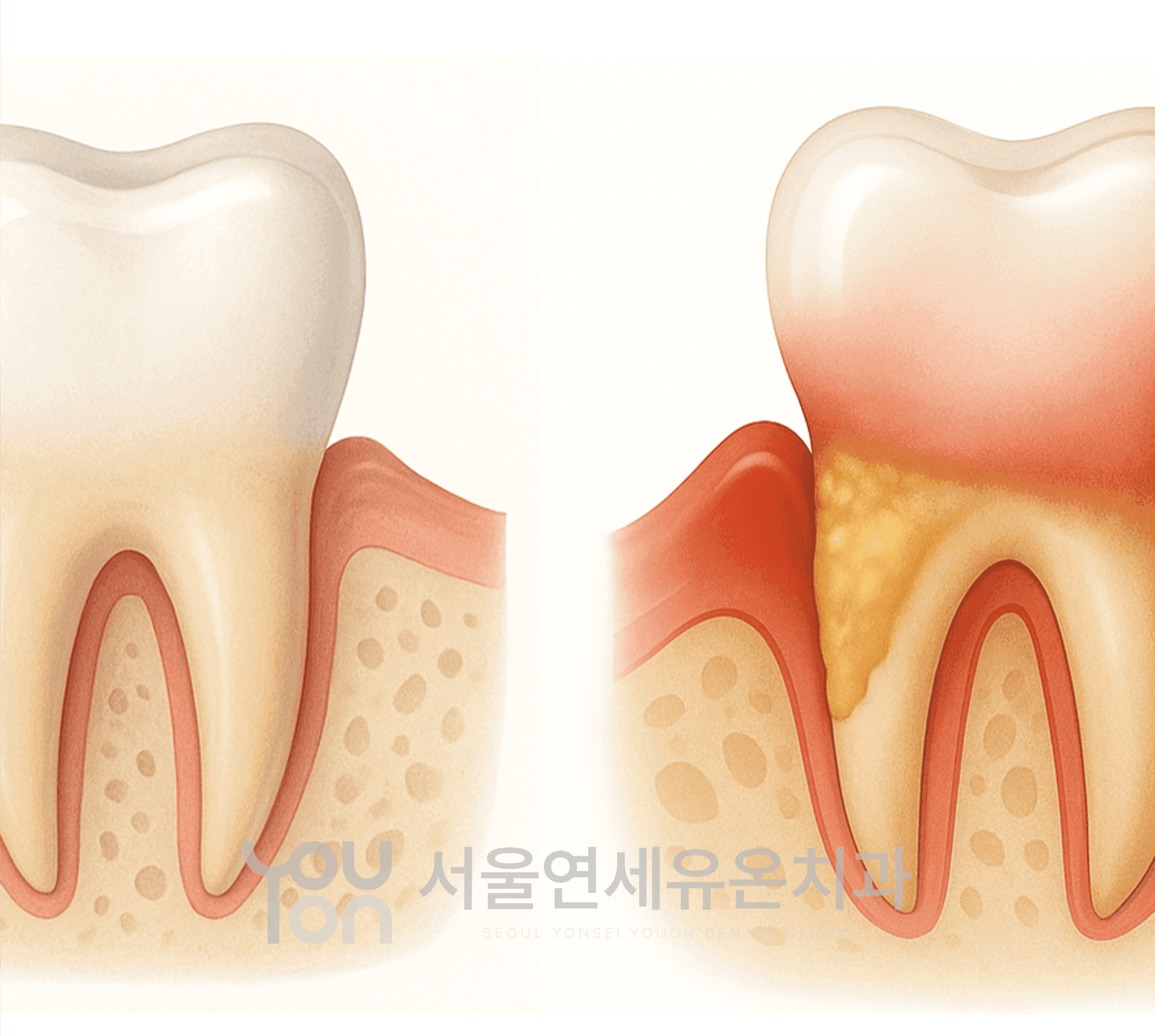 잇몸치료가 필요한 이유