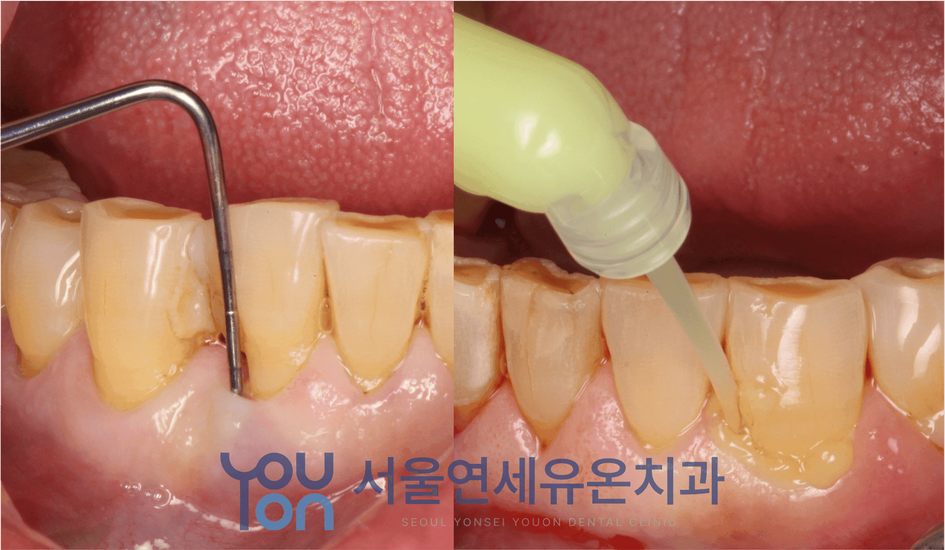 치주 진단