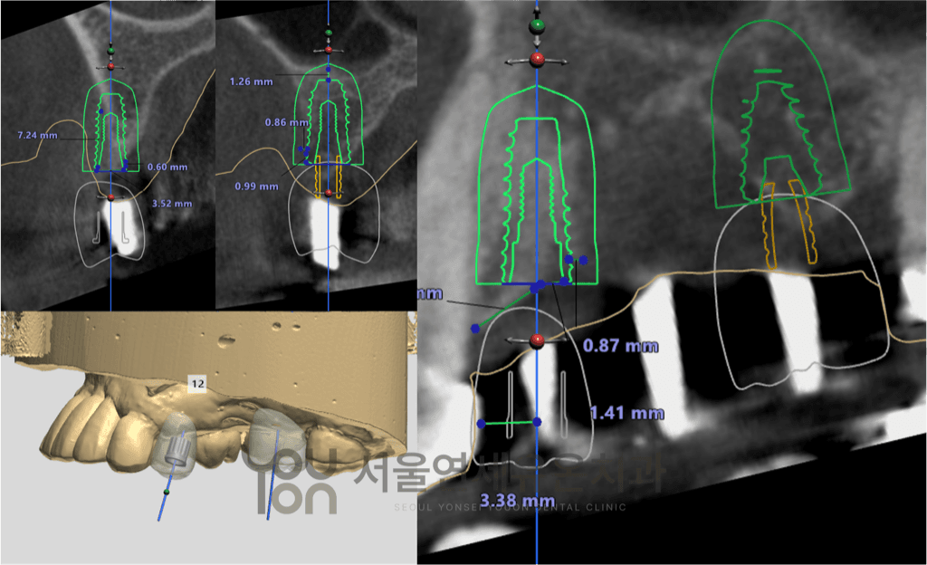 맞춤형 임플란트 치료