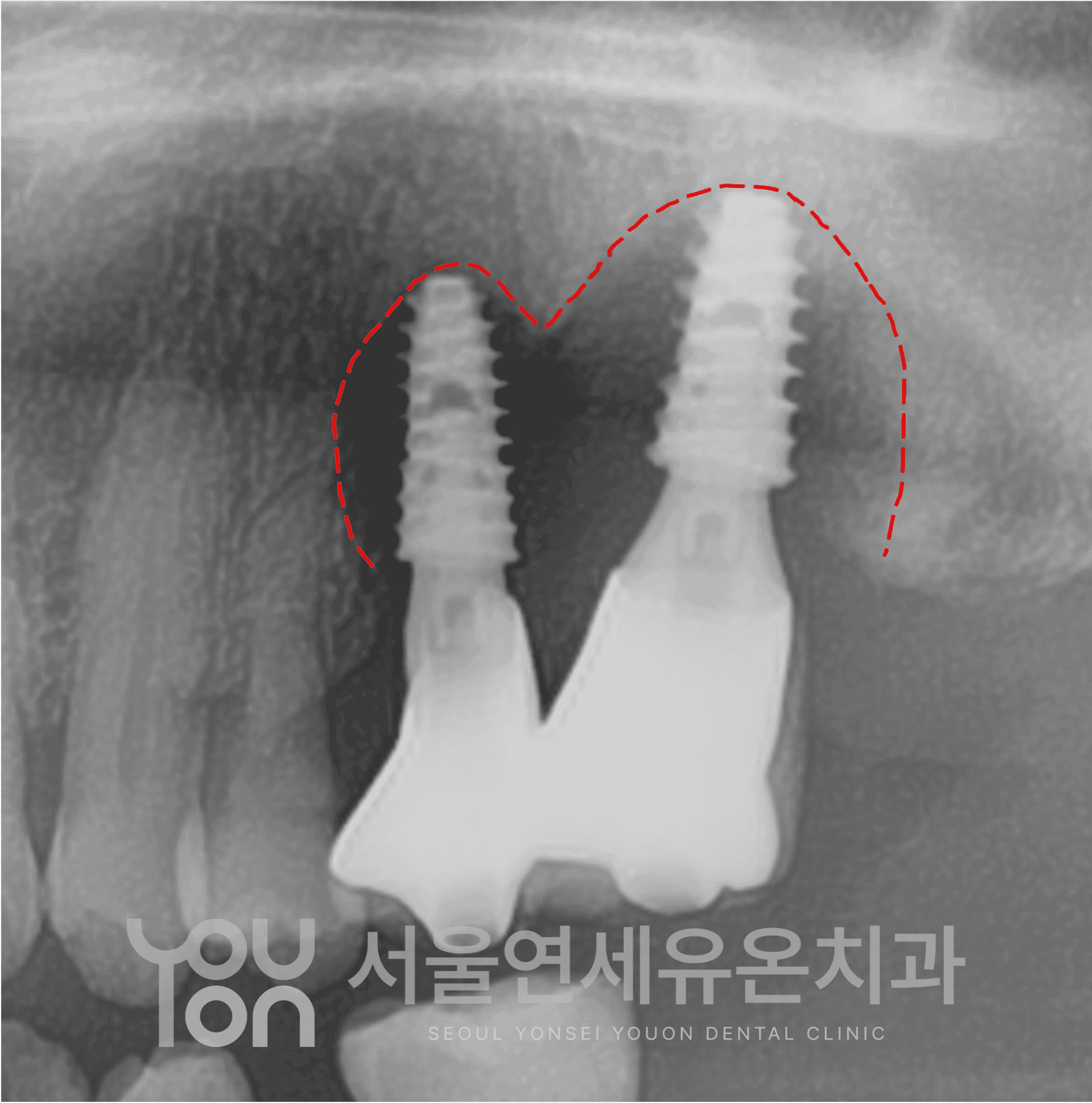 뼈 손실 분석