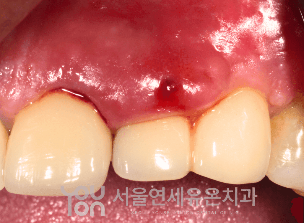 임플란트 주위염