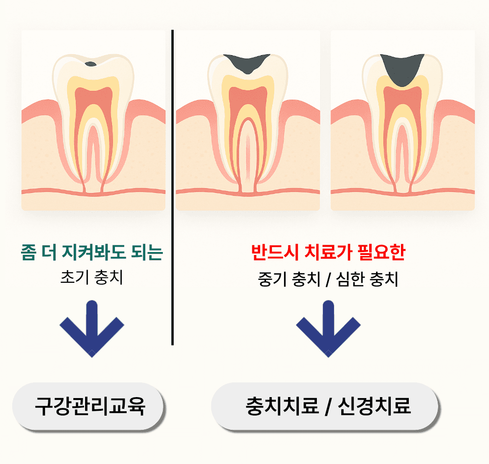 충치 진단