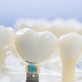 치주과는 무엇을 하나요?
- 잇몸 재생, 임플란트, 잇몸 이식